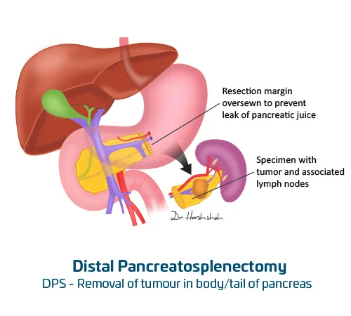 Distal Pancreatosplenectomy
