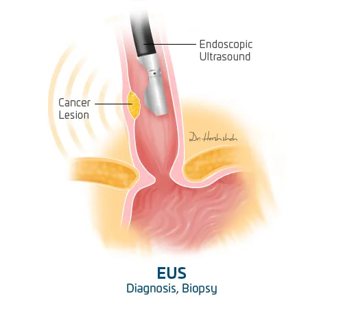 EUS for esophageal cancer treatment