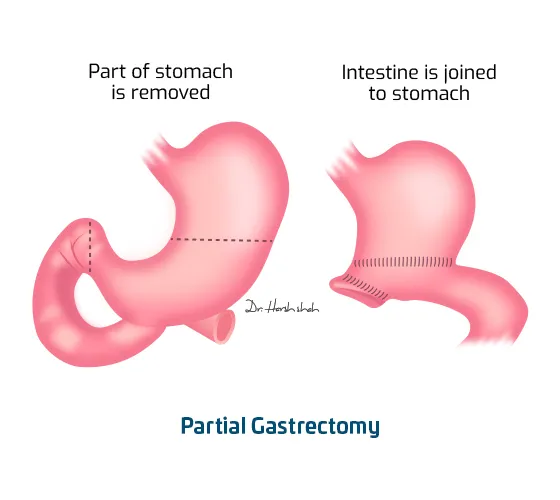 Partial-Gastrectomy 