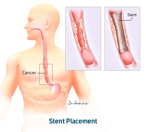Stenting Stent Placing for esophageal cancer treatment