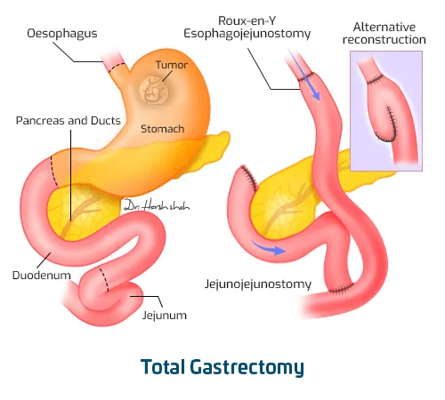 Total-Gastrectomy