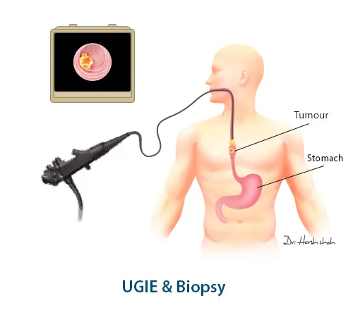 UGIE Biopsy for esophagus cancer