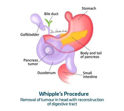 Whipple's Procedure
