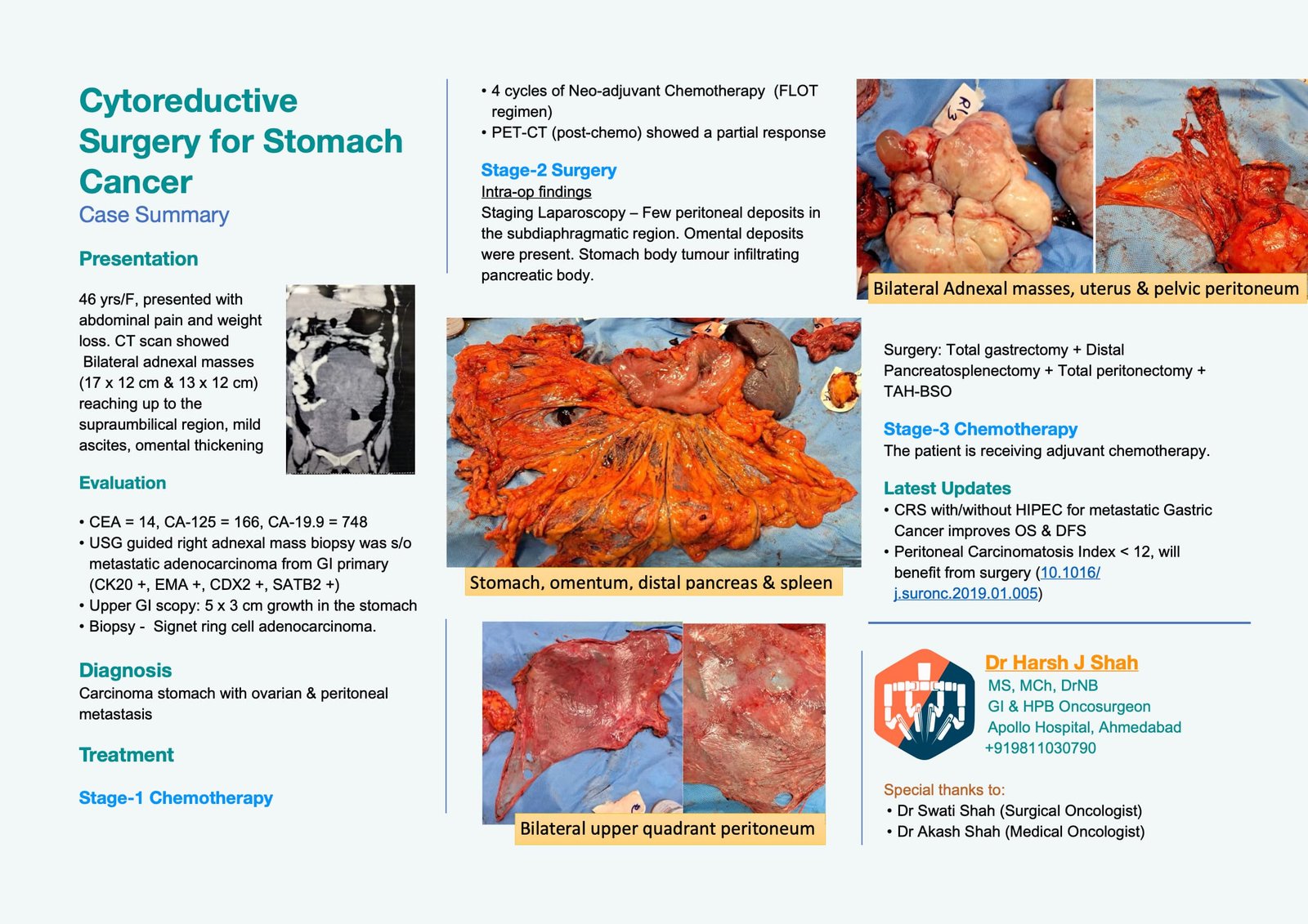 Cytoreductive Surgery for Stomach Cancer Case Summary
