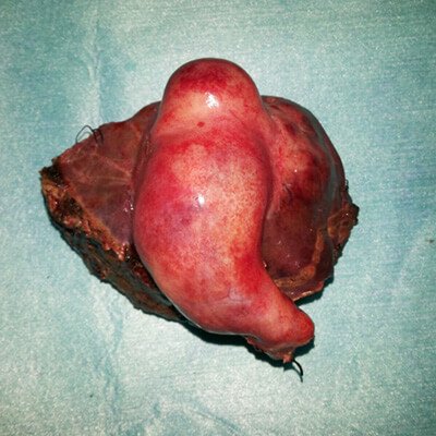 Gall bladder tumour thumb