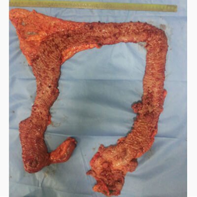 Multiple tumours in large intestine thumb