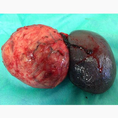 Pancreatic body tumour thumb