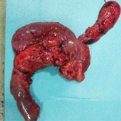 Pancreatic head tumour thumb