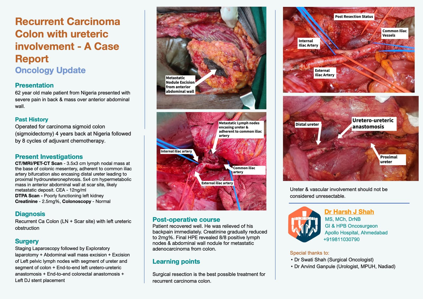 Recurrent Carcinoma Colon with ureteric involvement A Case Report