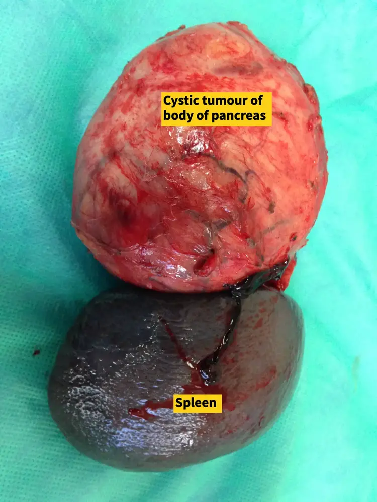 Pancreas Tumour treatment in Ahmedabad