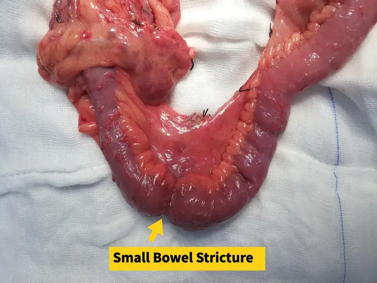 Small bowel stricture specialist in Ahmedabd, India