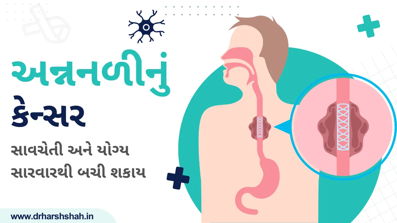 અન્નનળીનું કેન્સર: સાવચેતી અને યોગ્ય સારવારથી બચી શકાય