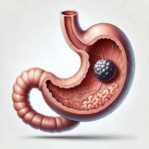 Stomach Cancer