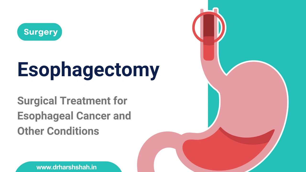 Esophagectomy