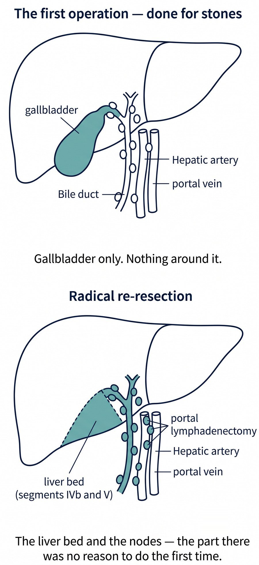 Two diagrams: the first operation for stones removed the gallbladder only; radical re-resection removes the liver bed (segments IVb and V) and the lymph nodes along the bile duct, hepatic artery and portal vein.