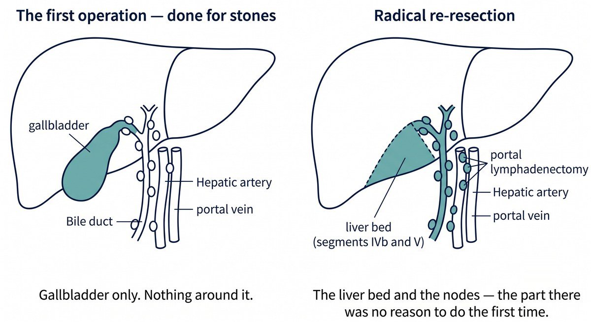 Two diagrams: the first operation for stones removed the gallbladder only; radical re-resection removes the liver bed (segments IVb and V) and the lymph nodes along the bile duct, hepatic artery and portal vein.