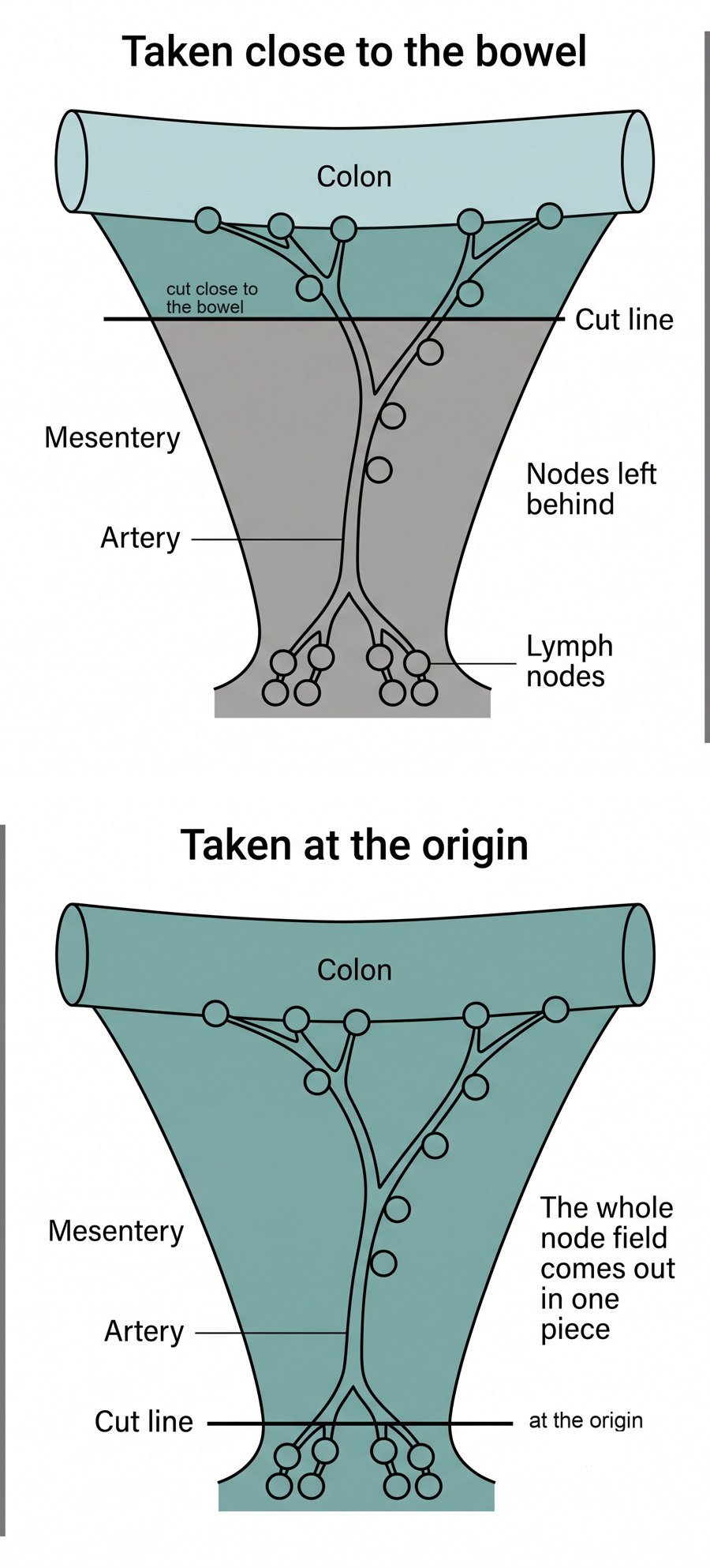 Two diagrams of the colon and its mesentery: on the left the cut is close to the bowel and lymph nodes are left behind; on the right the cut is at the artery's origin and the whole node field is removed in one piece.